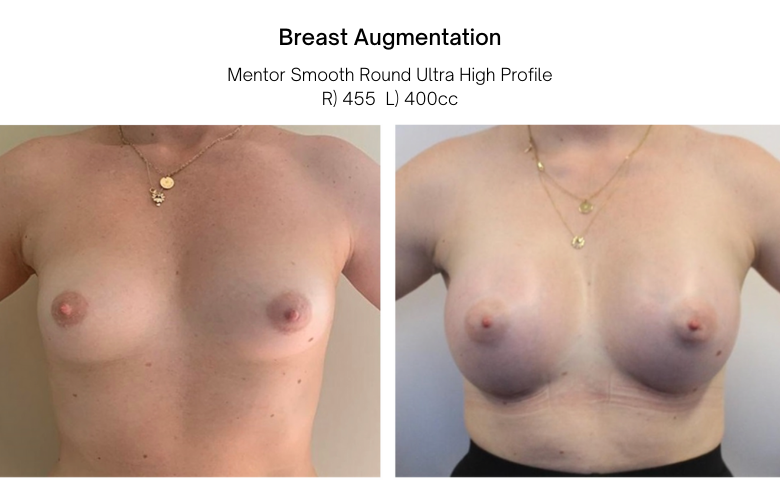breast aug photos before and after