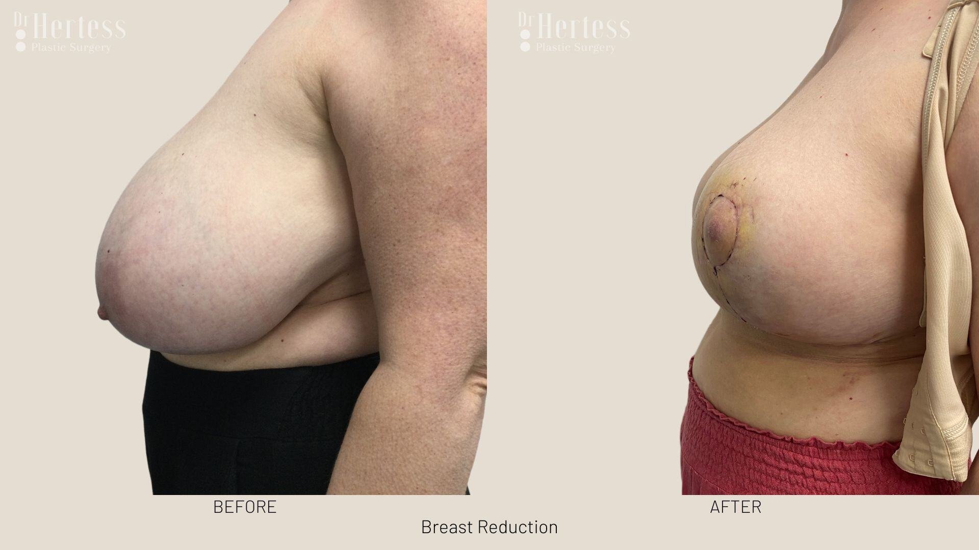 breast reduction before and after