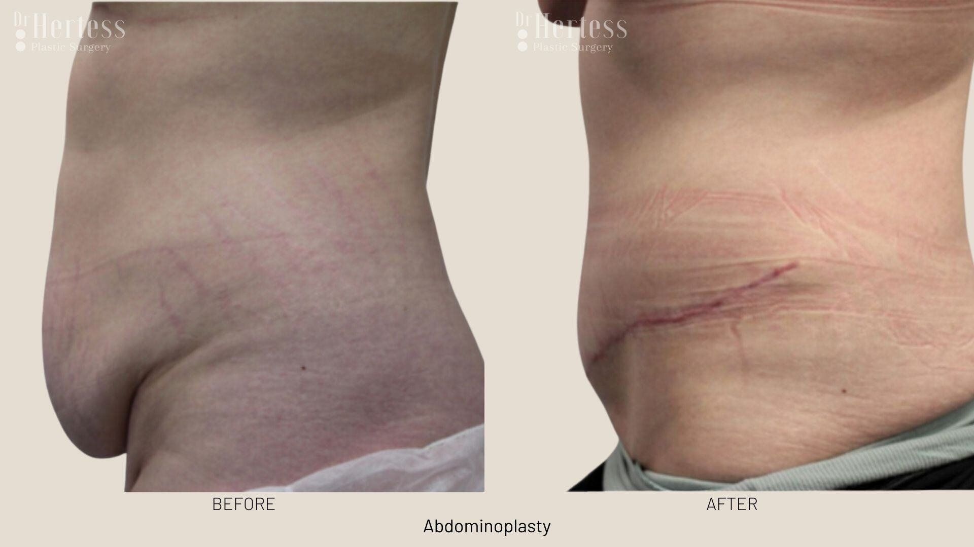 abdominoplasty before and after photos