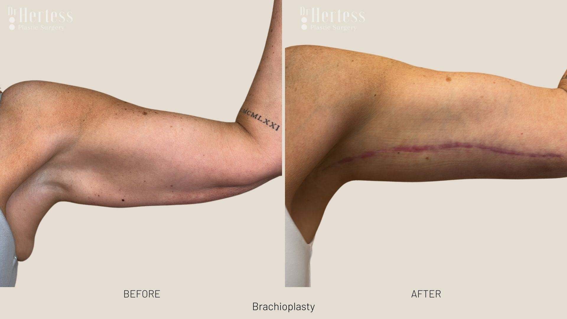 arm lift before and after photos