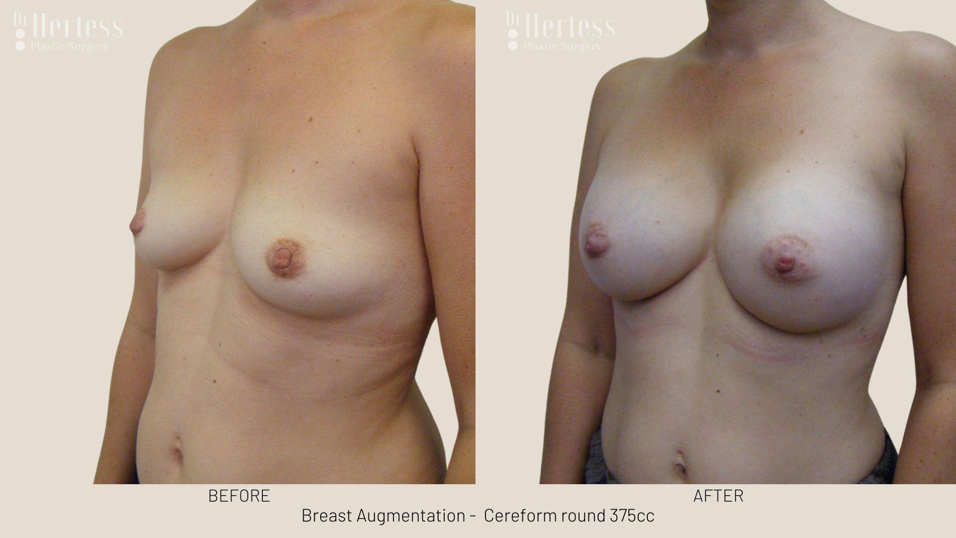 boob job photos before and after