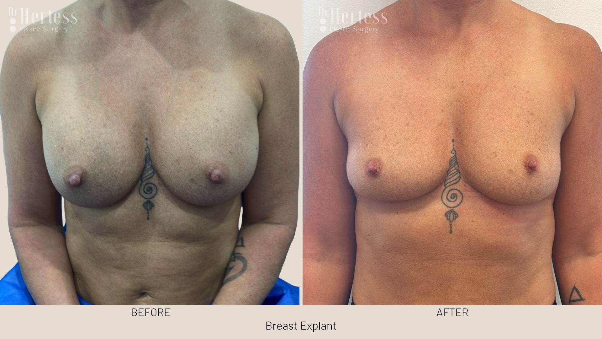 breast implant removal photos