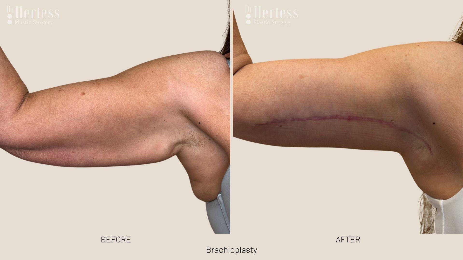 arm lift before and after photos