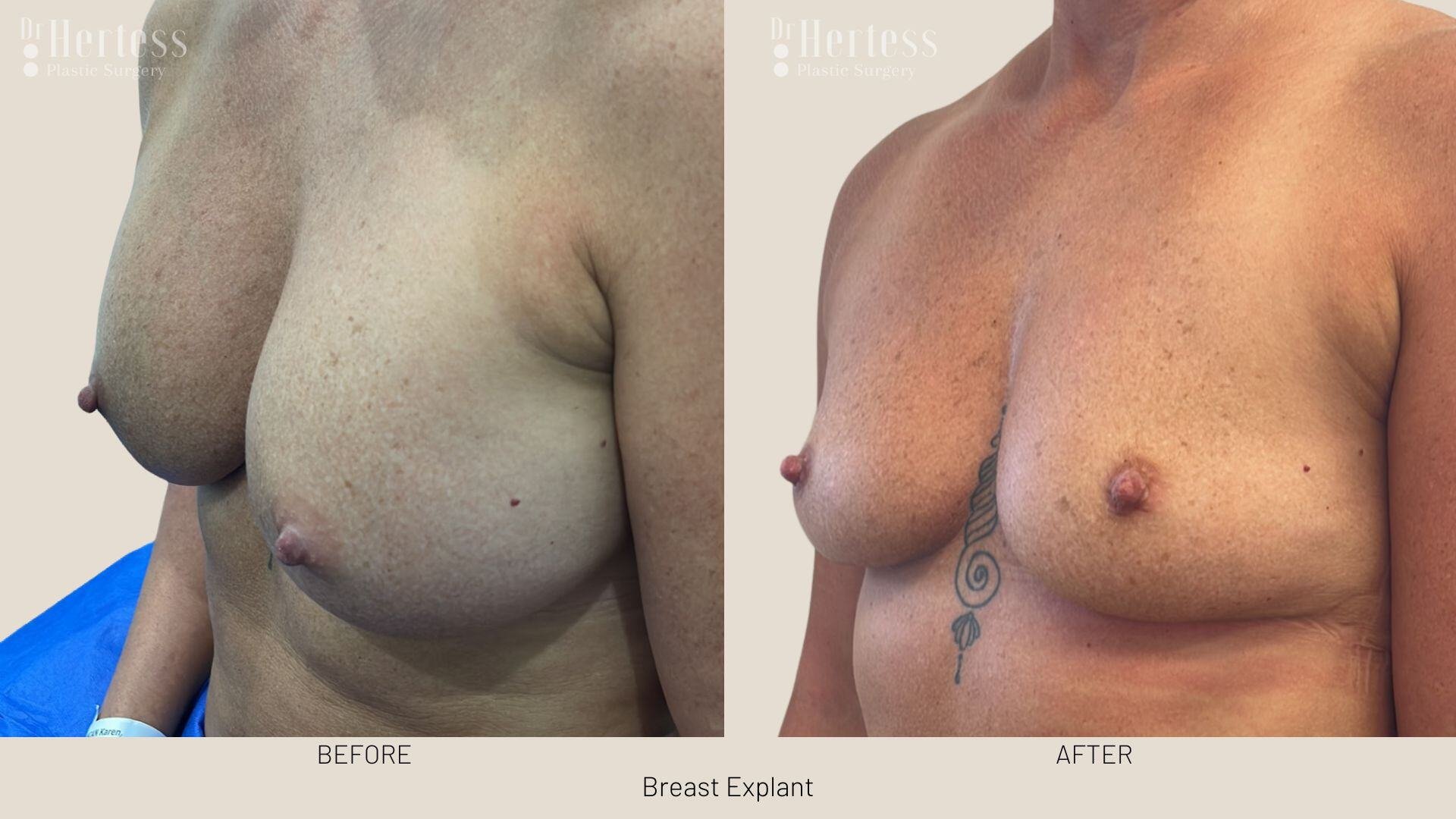 breast implant removal photos