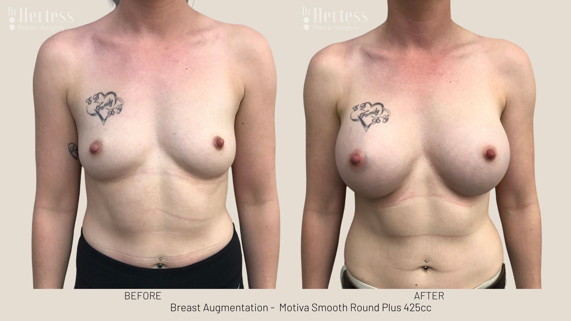 boob job photos before and after