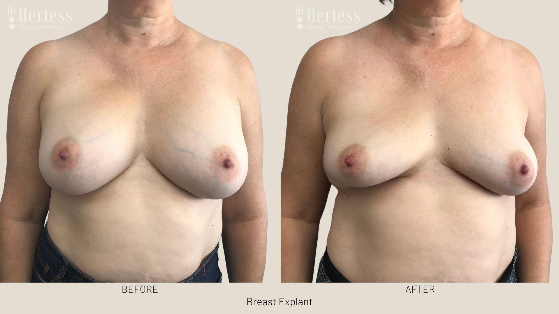 breast implant removal photos