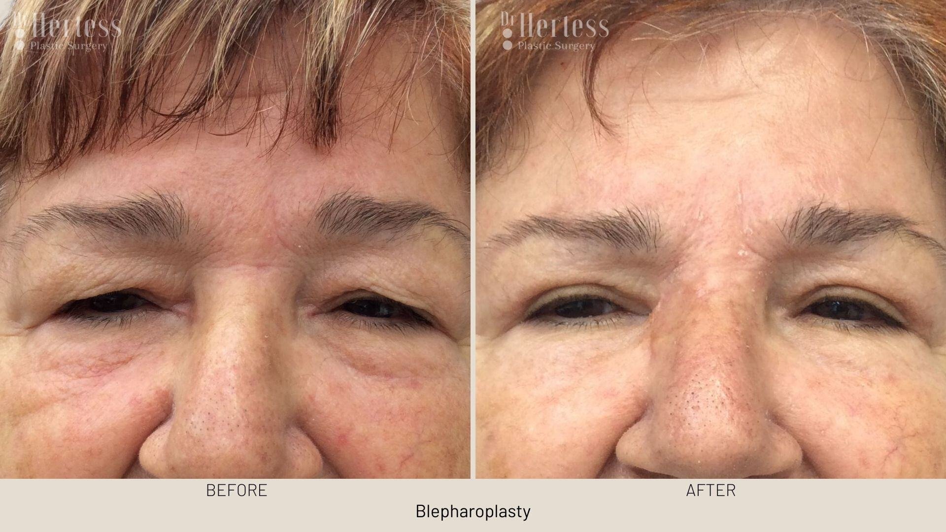 bleph surgery before and after