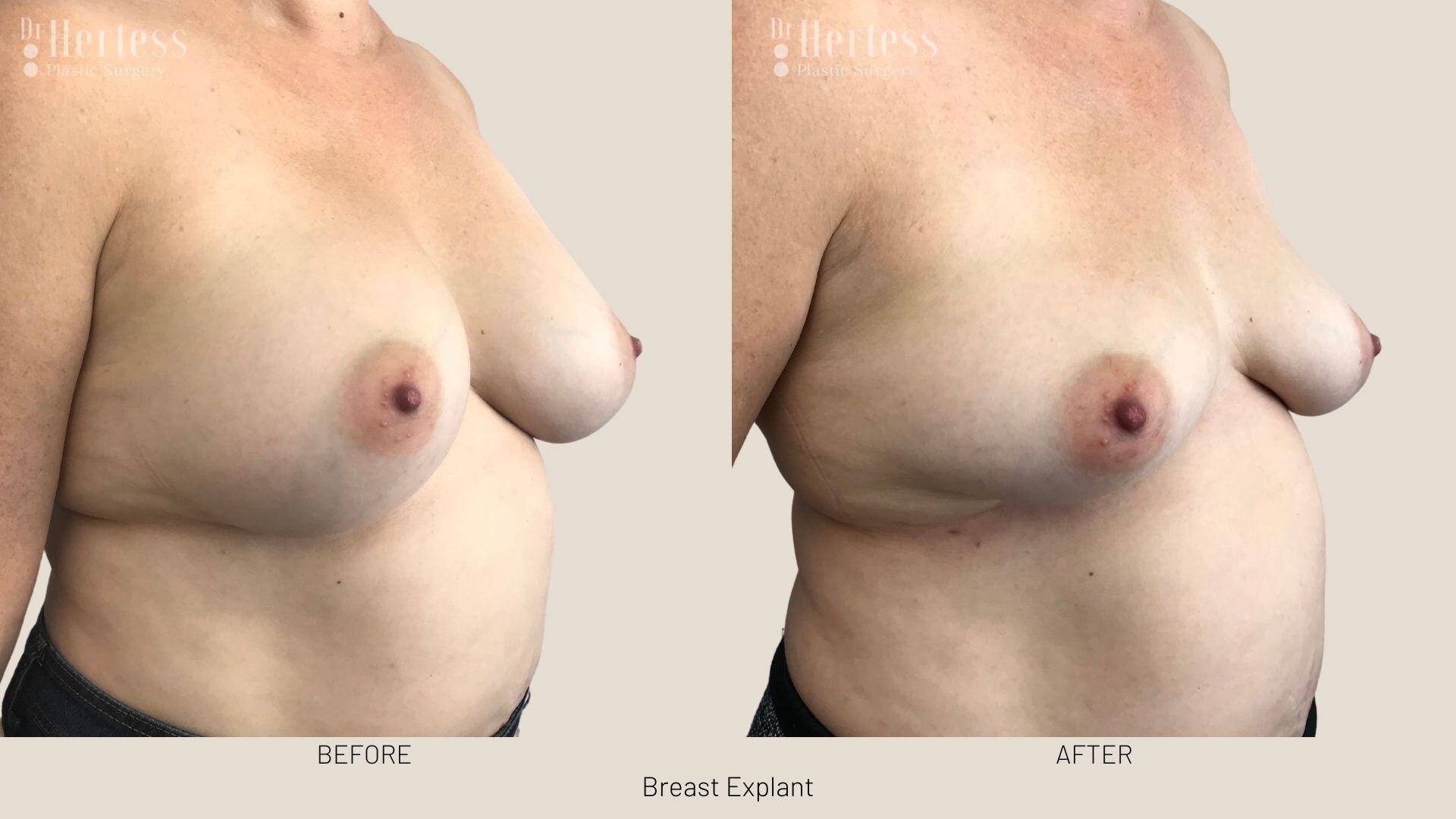 breast implant removal photos