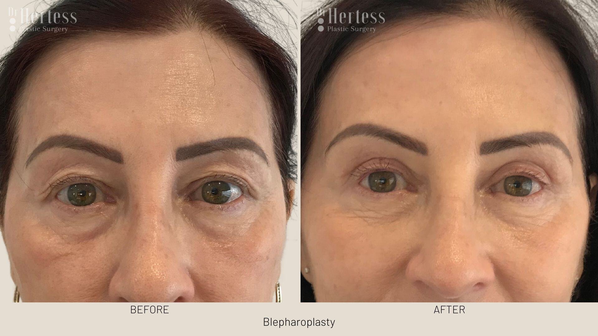 bleph surgery before and after