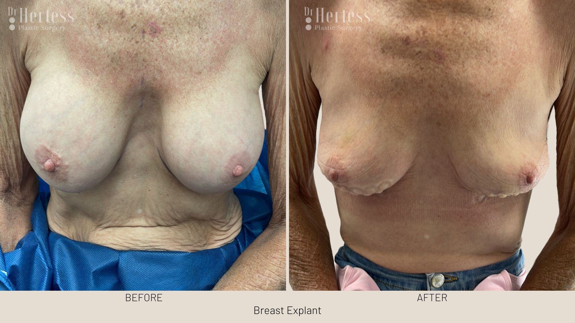 breast implant removal photos