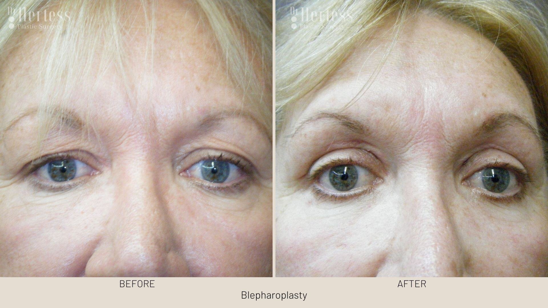 bleph surgery before and after