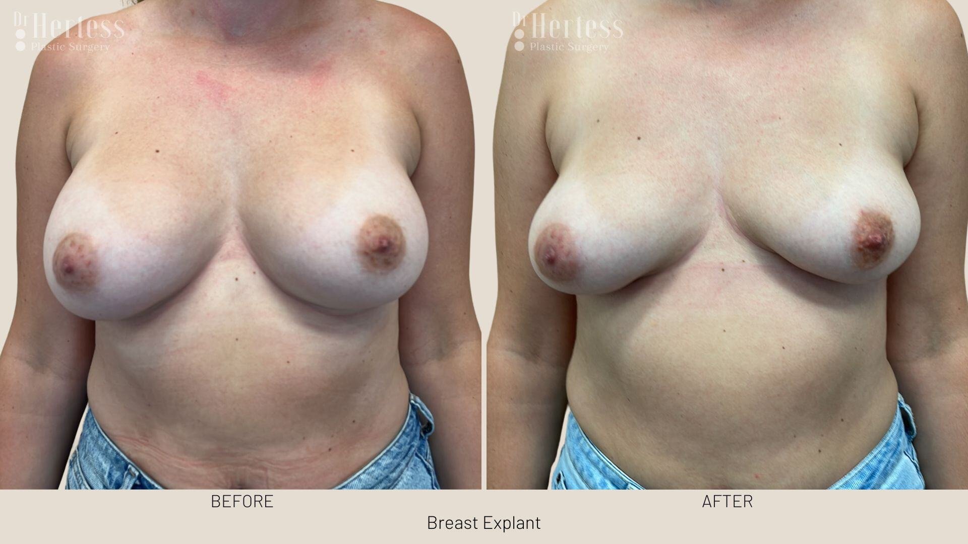 breast implant removal photos