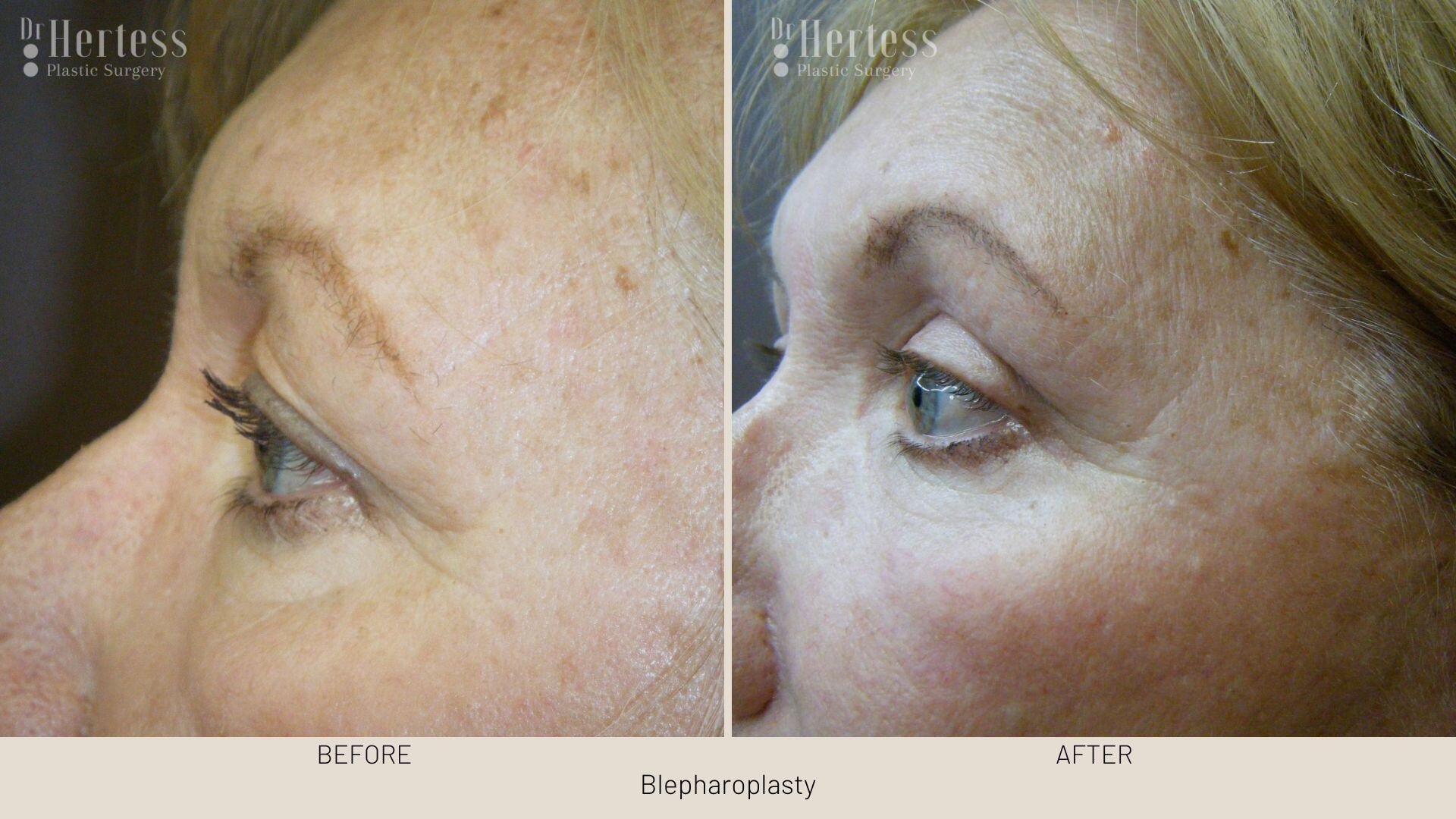 bleph surgery before and after
