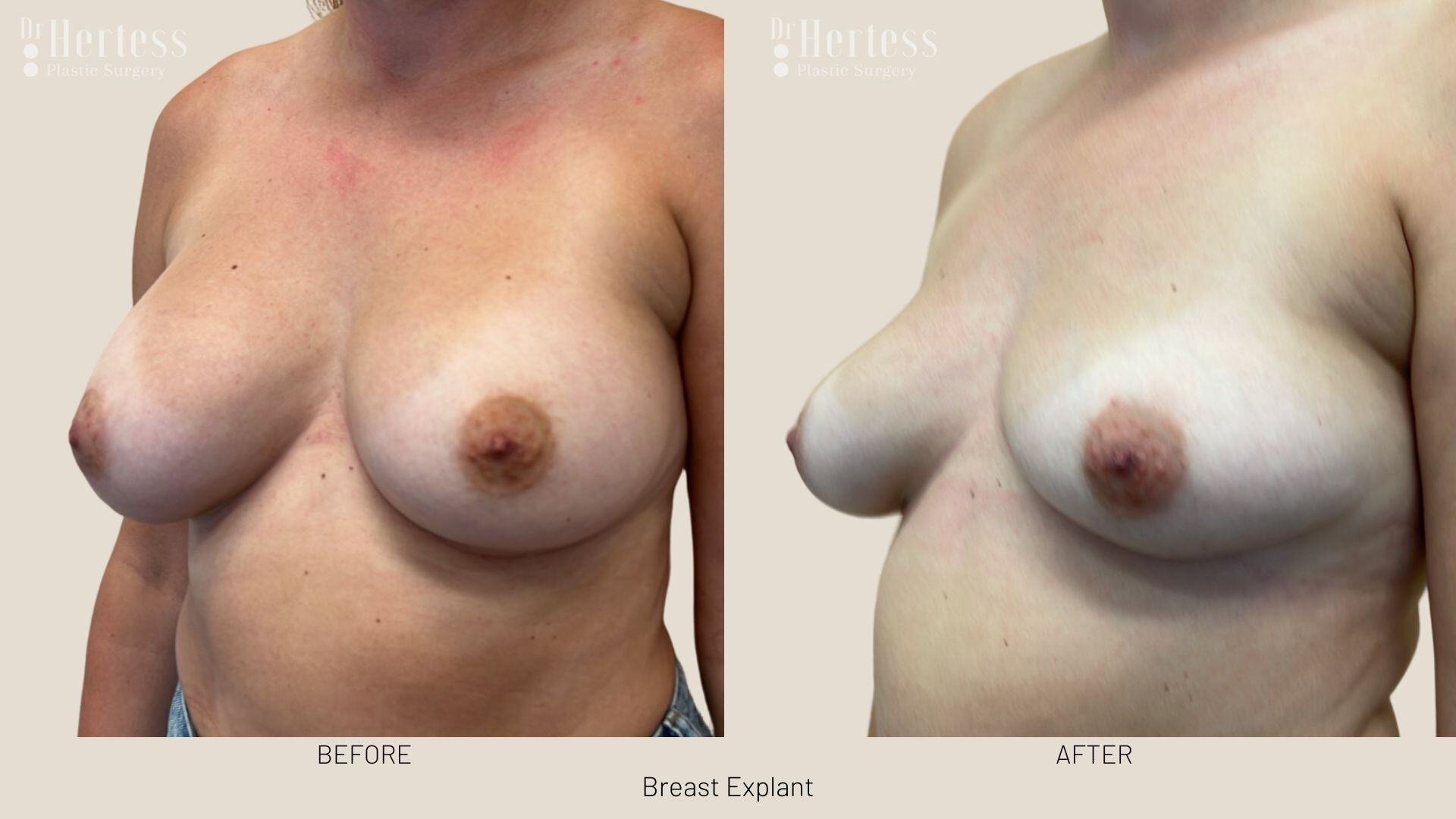 breast implant removal photos