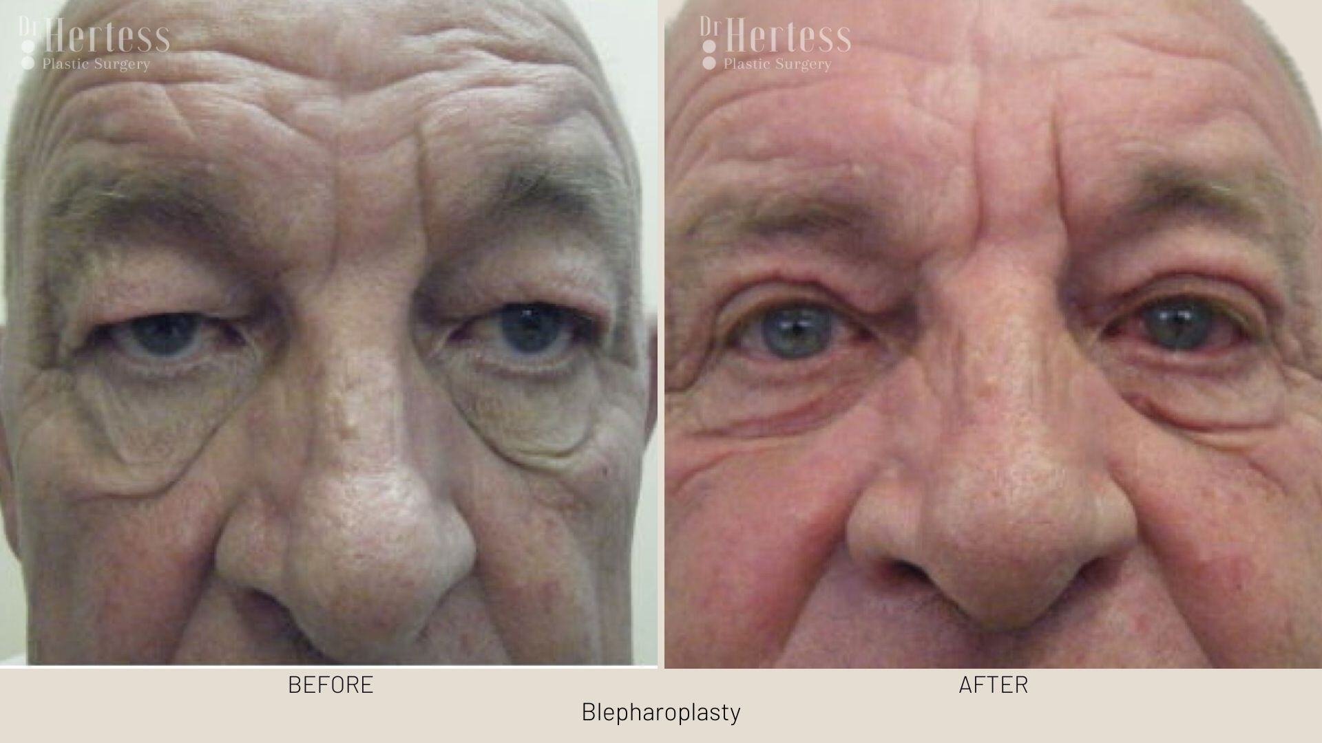 bleph surgery before and after