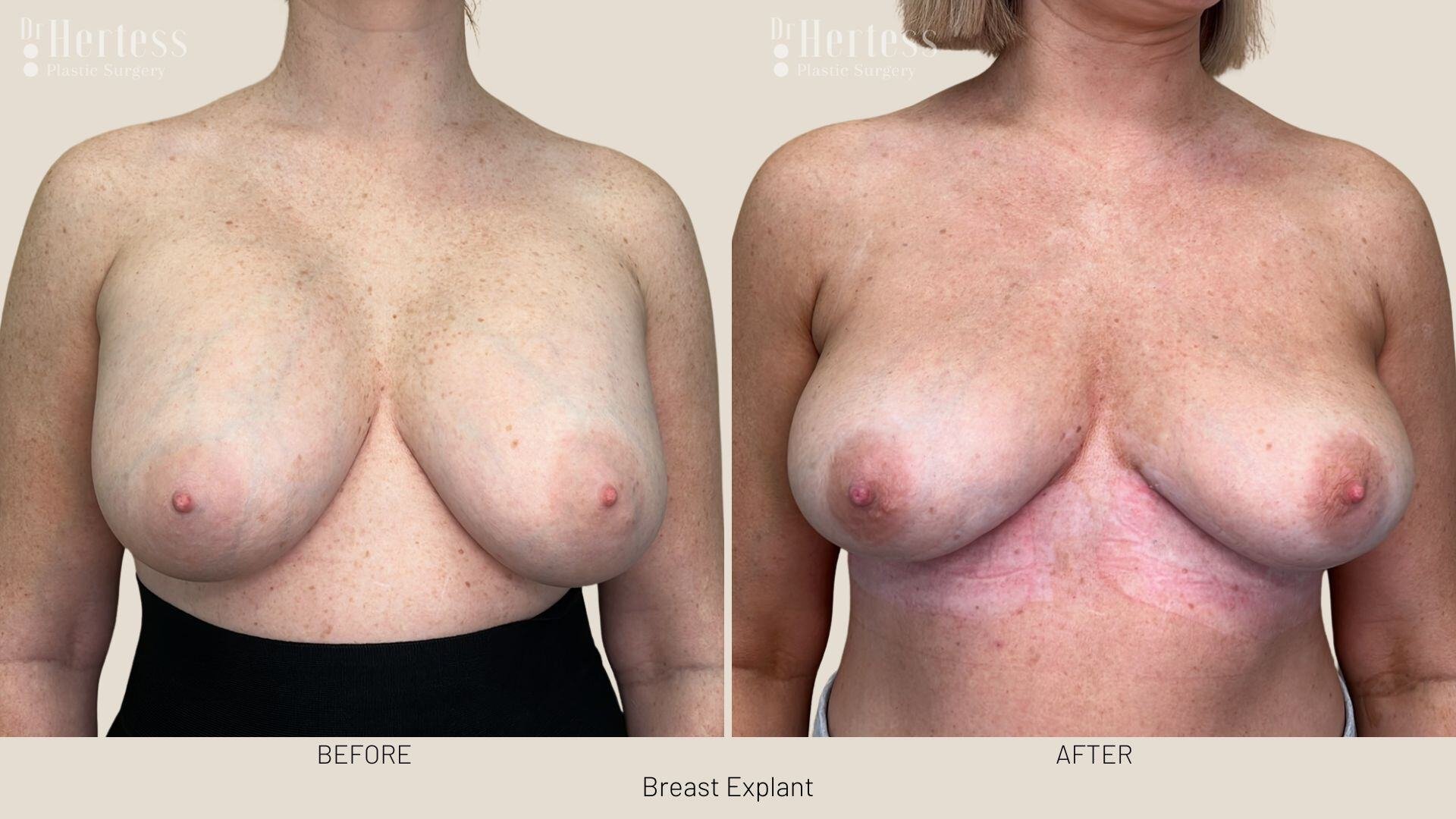 breast implant removal photos