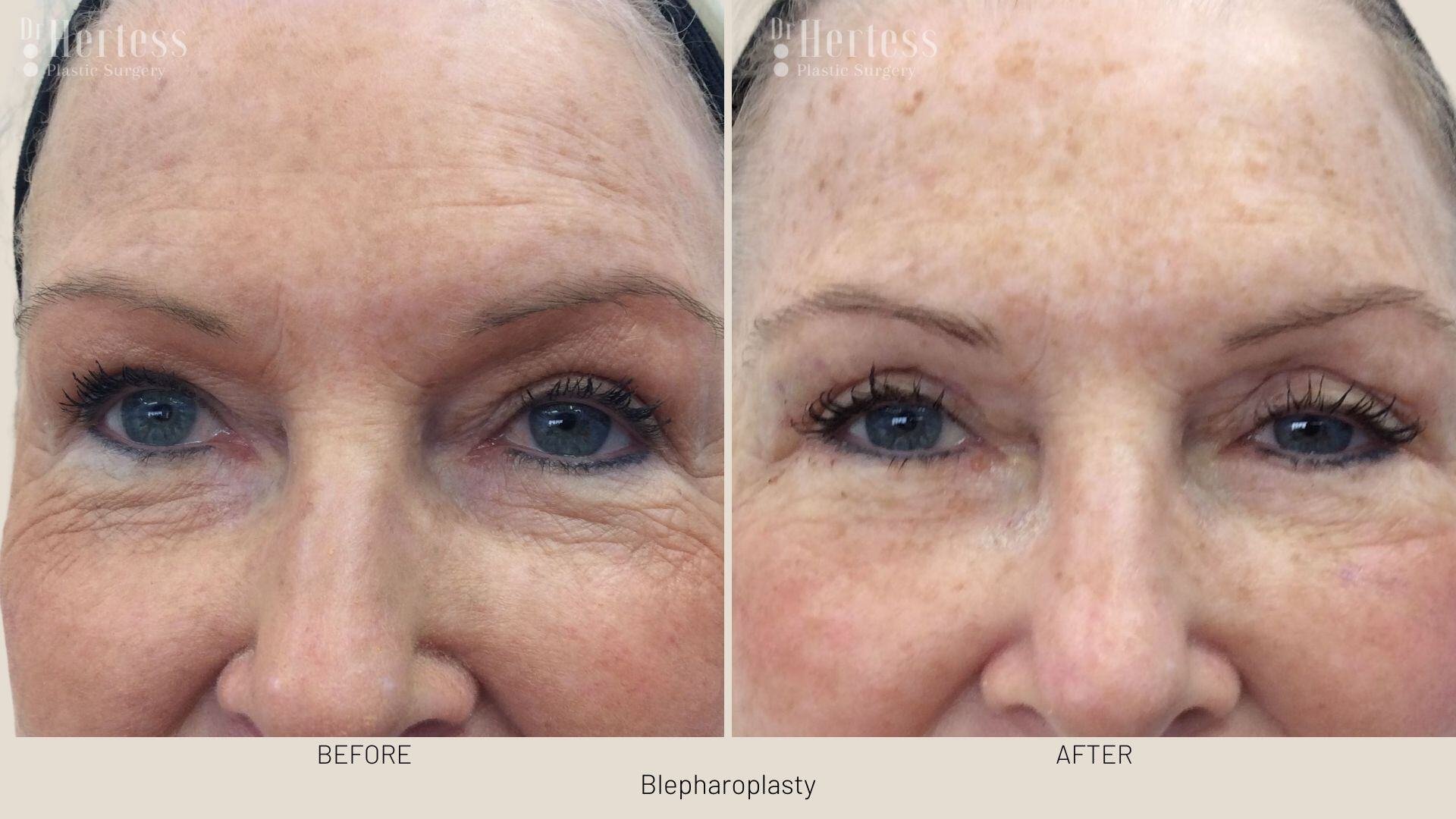 bleph surgery before and after