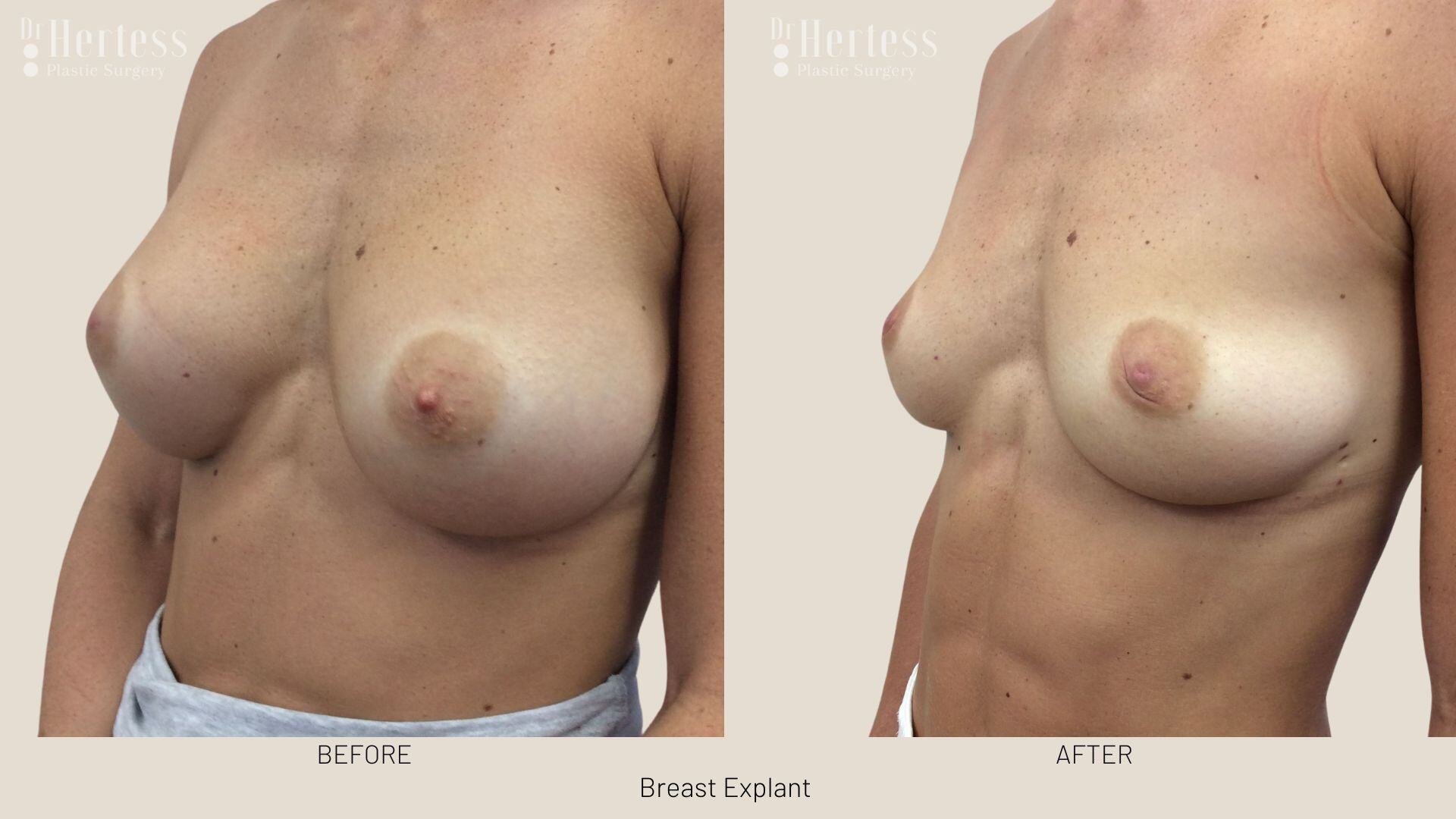 breast implant removal photos