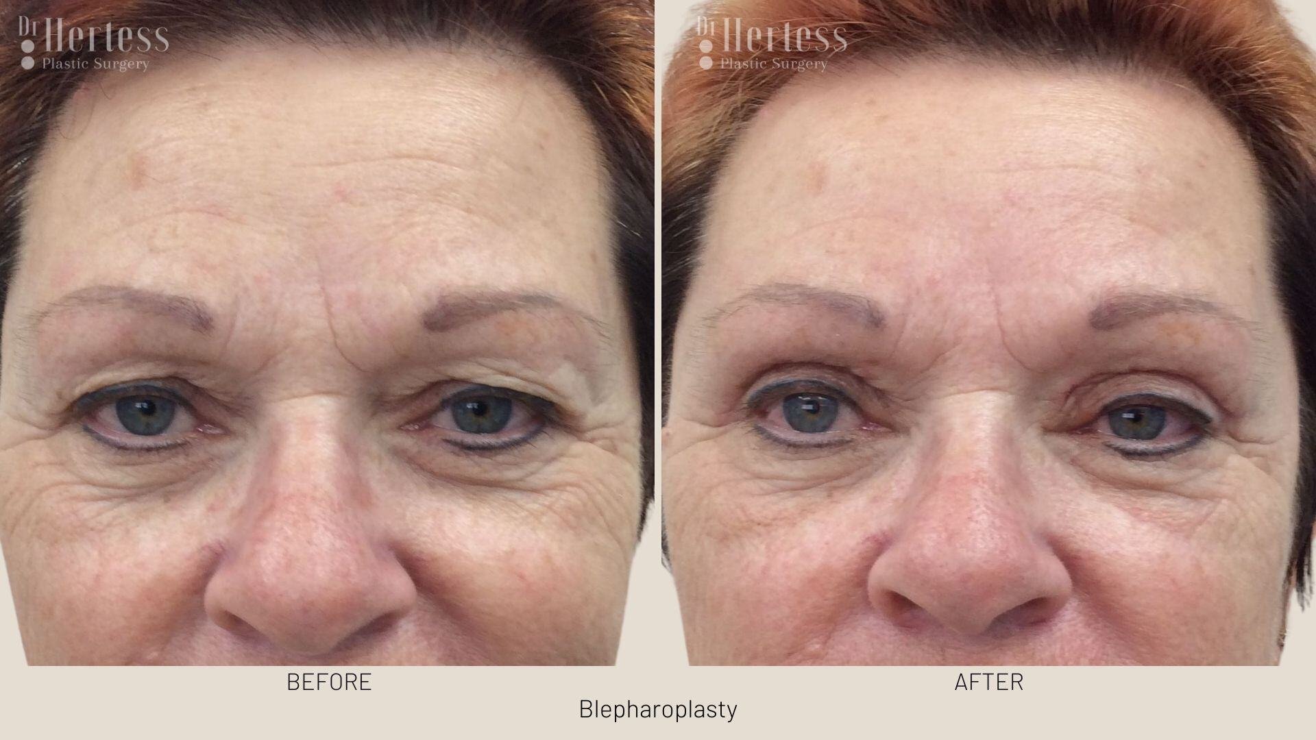 bleph surgery before and after