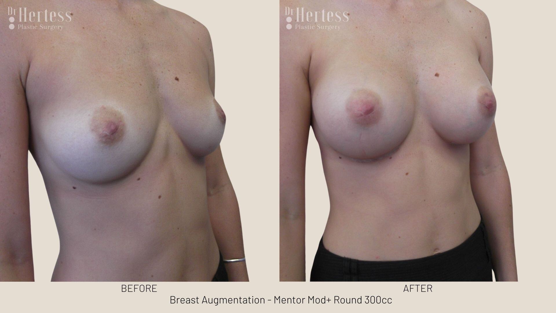 breast implants before and after