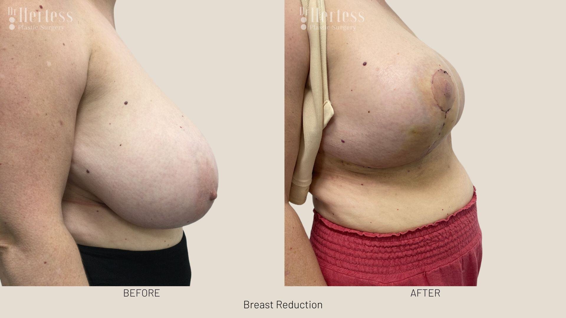 breast reduction before and after