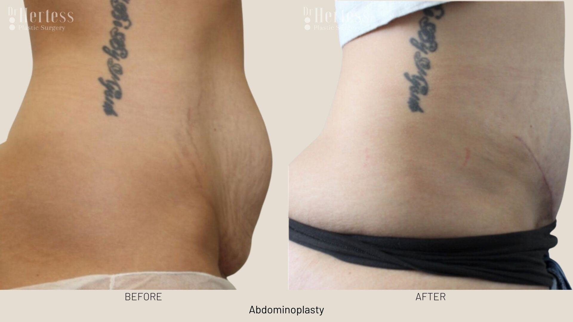 abdominoplasty before and after photos