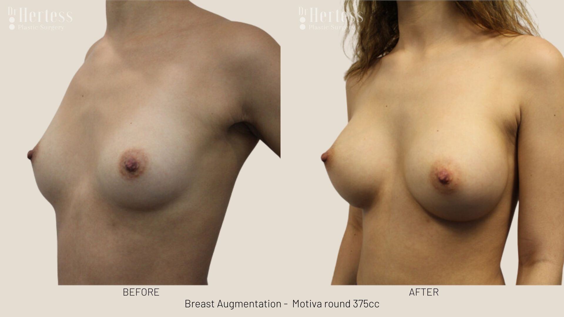 boob job photos before and after