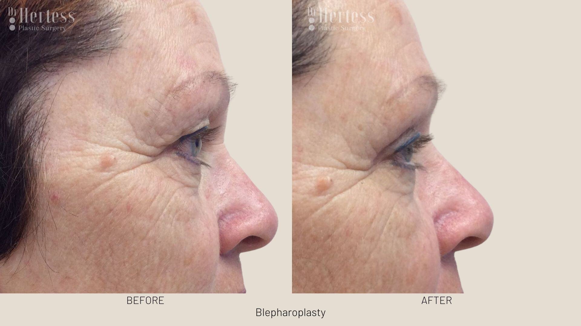 bleph surgery before and after