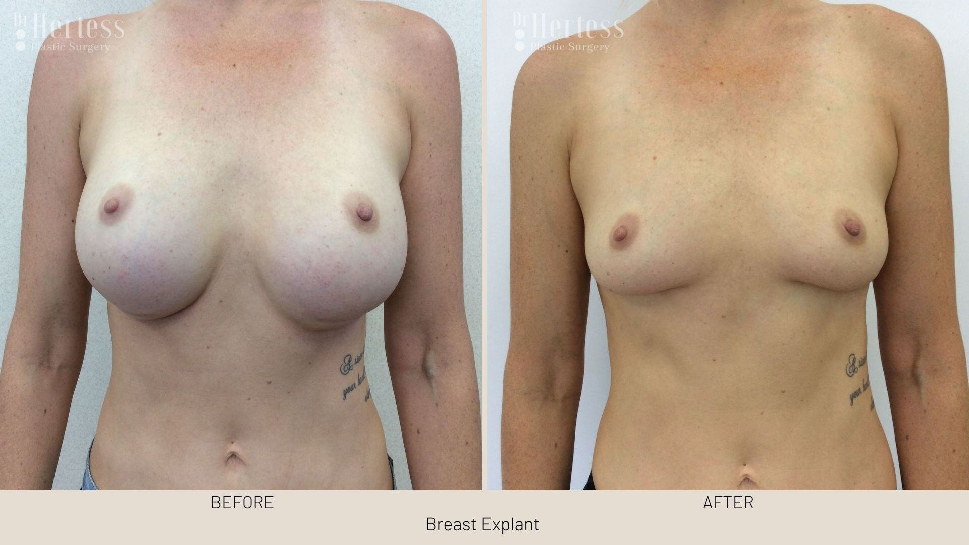 breast implant removal photos