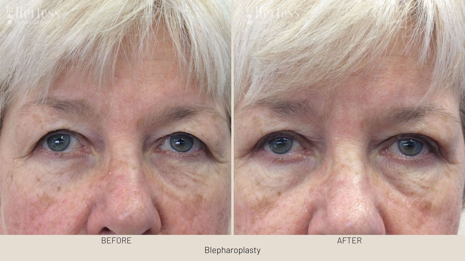 bleph surgery before and after