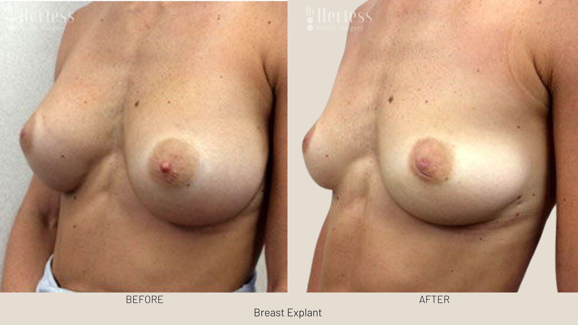 breast implant removal photos