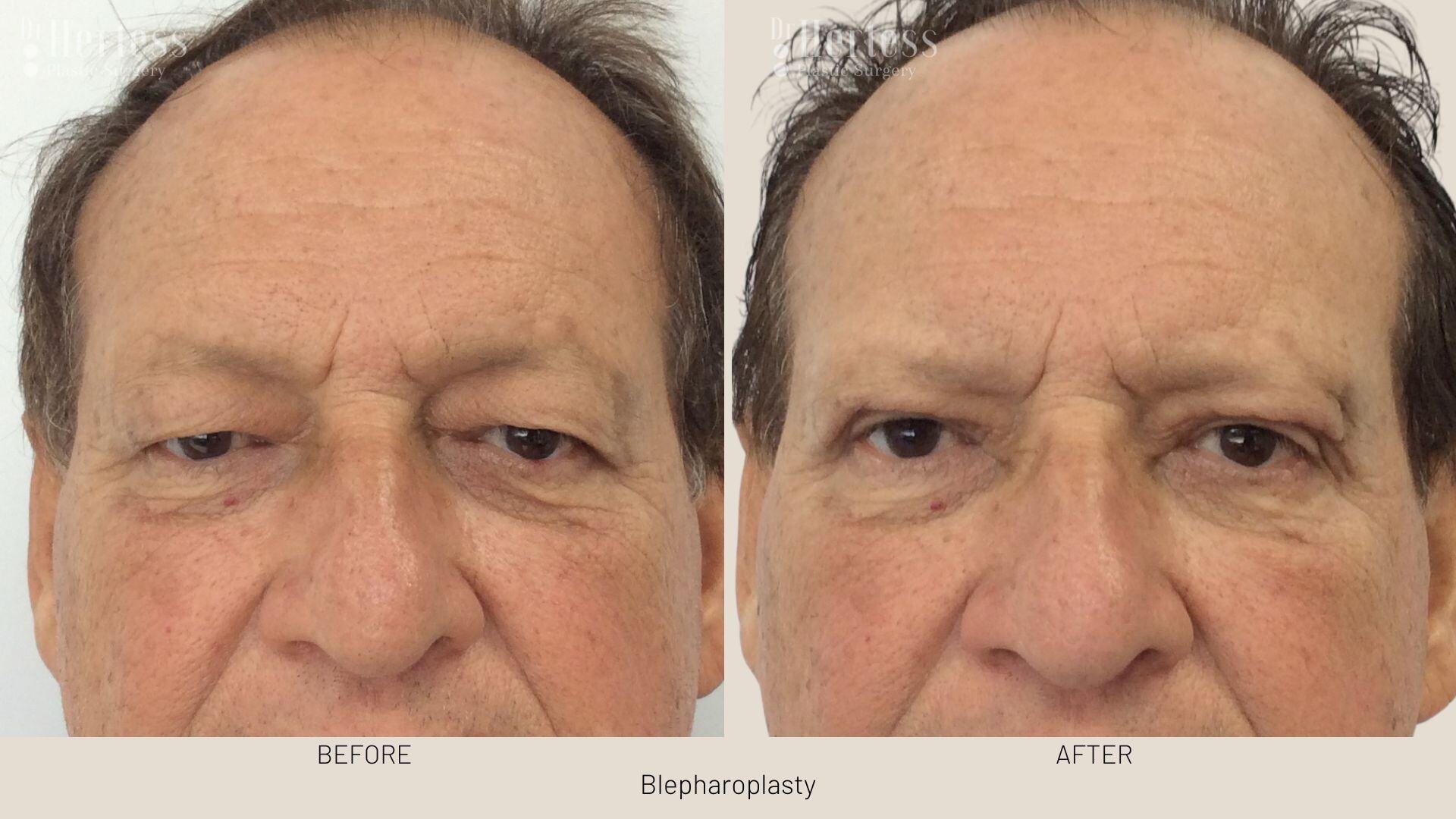 bleph surgery before and after
