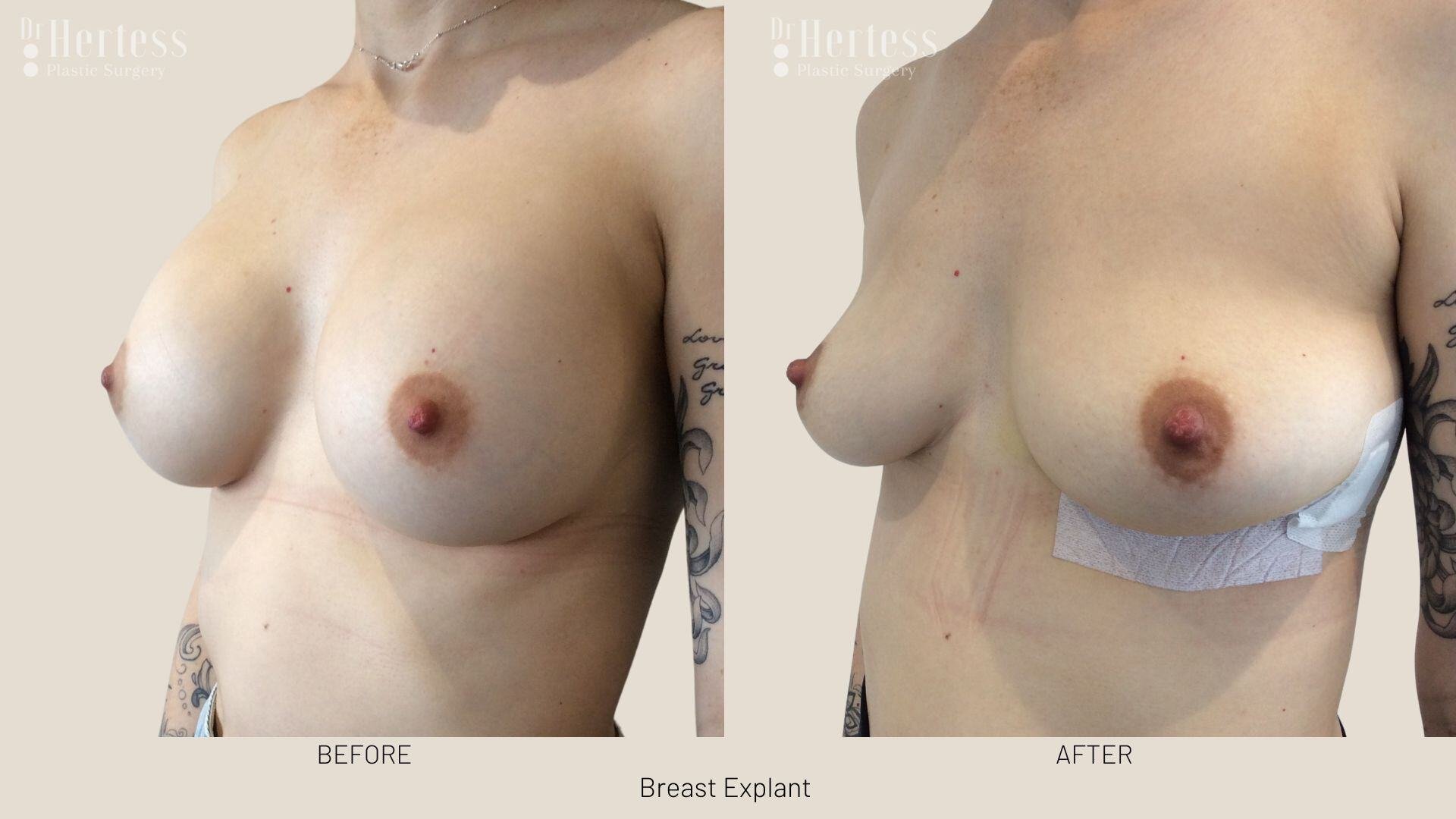 breast implant removal photos