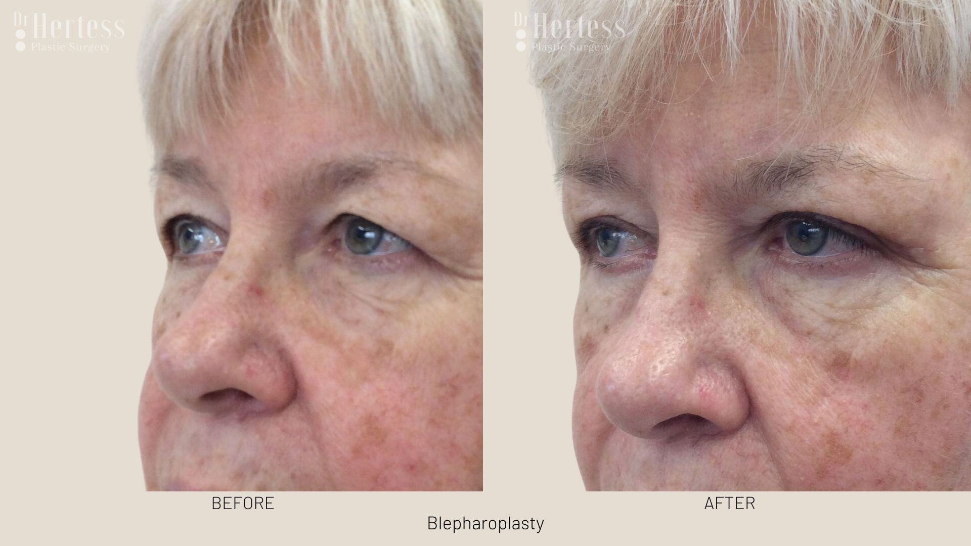 bleph surgery before and after
