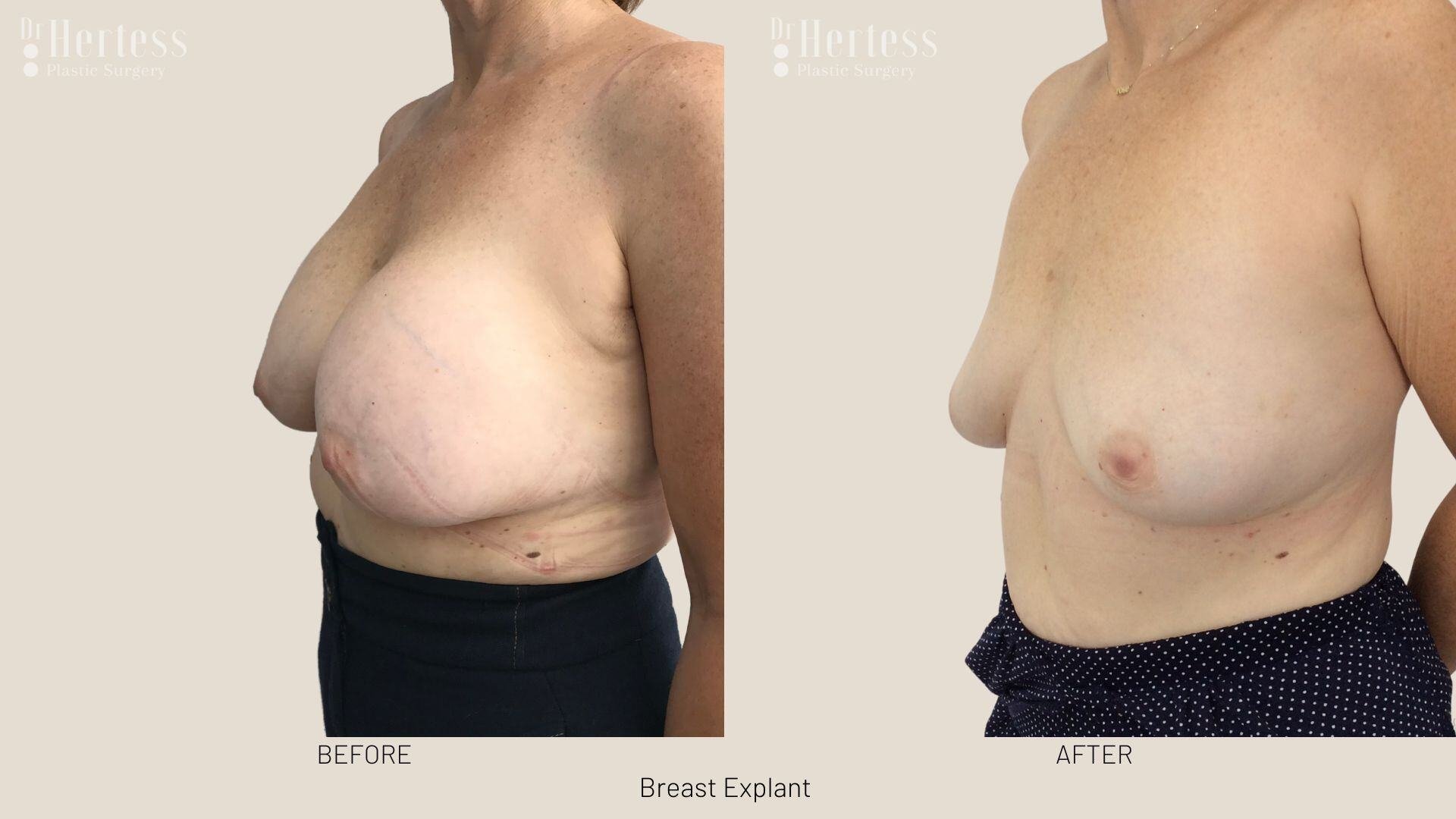 breast implant removal photos