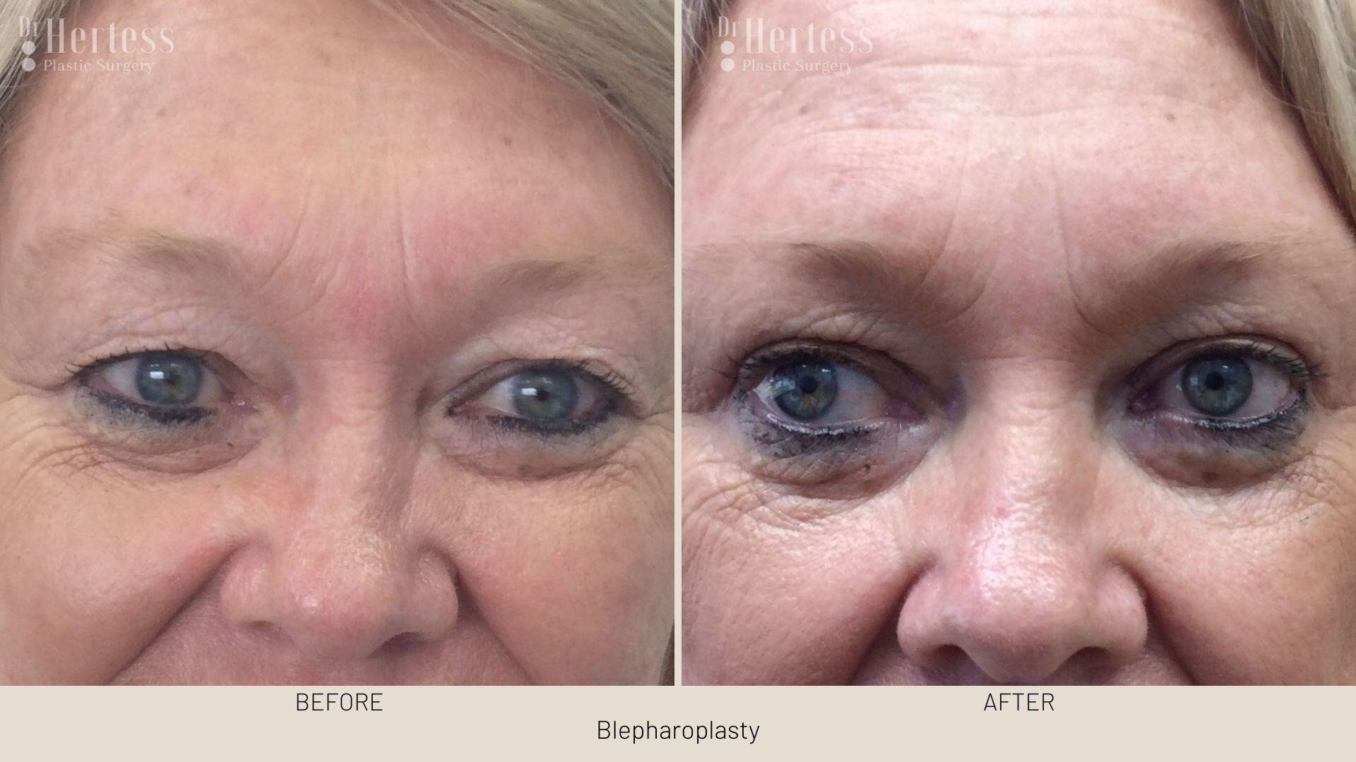 bleph surgery before and after