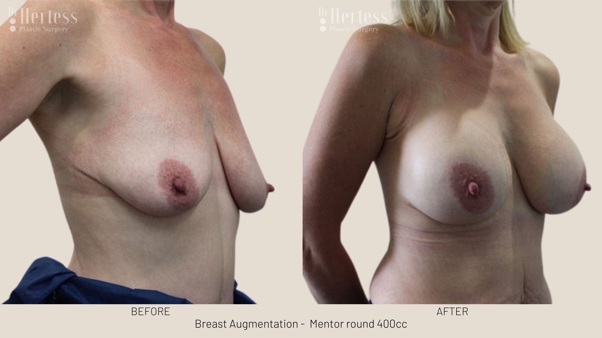 boob job photos before and after
