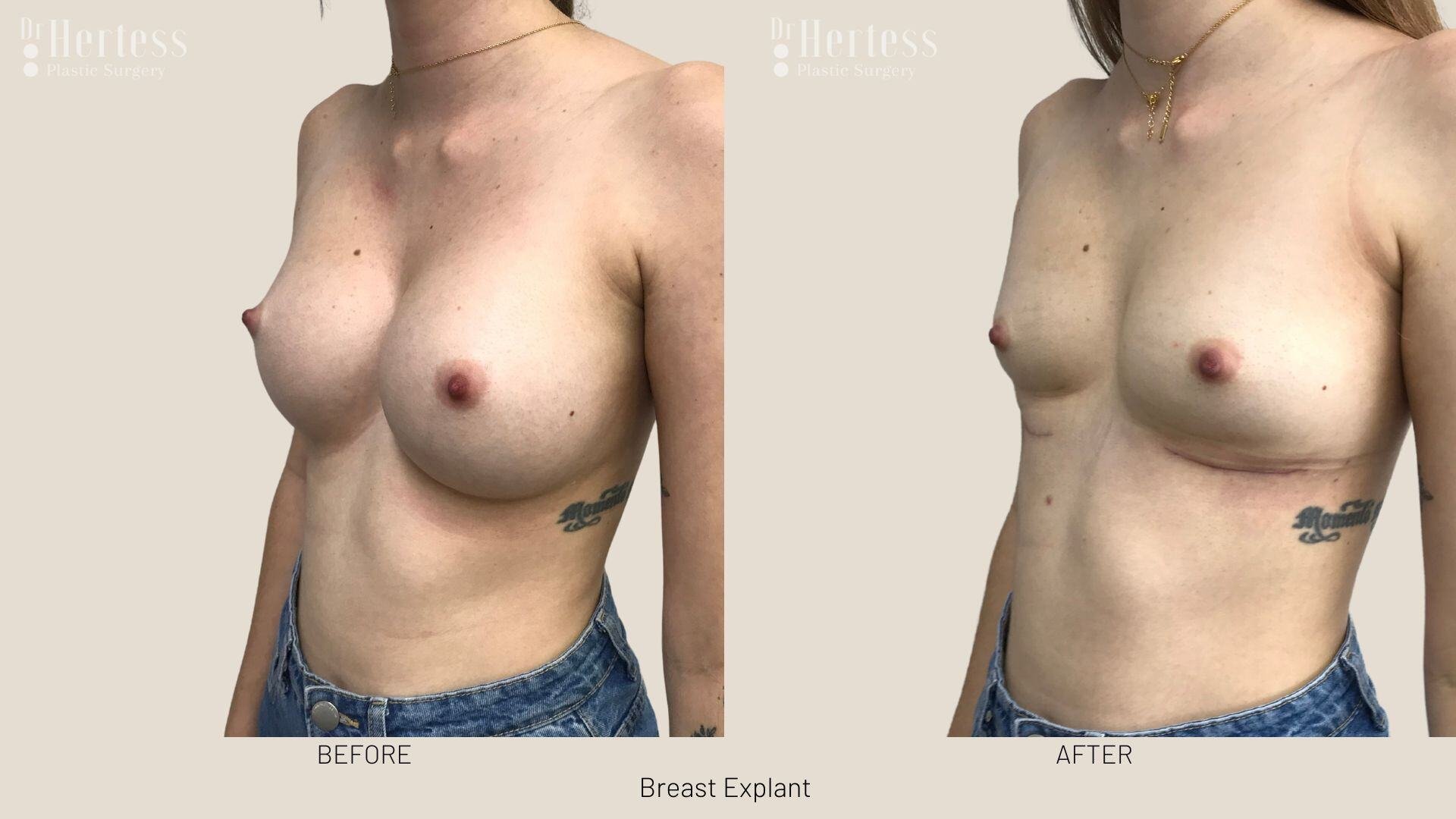 breast implant removal photos