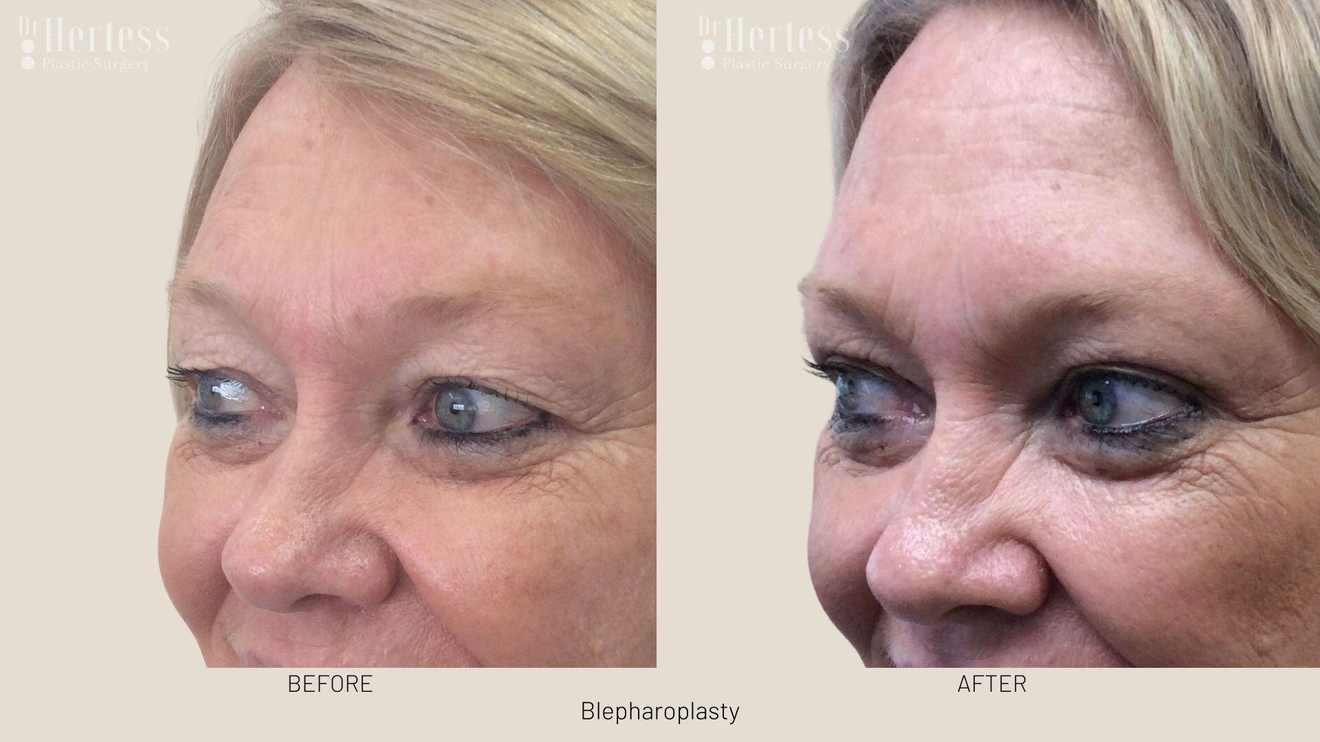 bleph surgery before and after