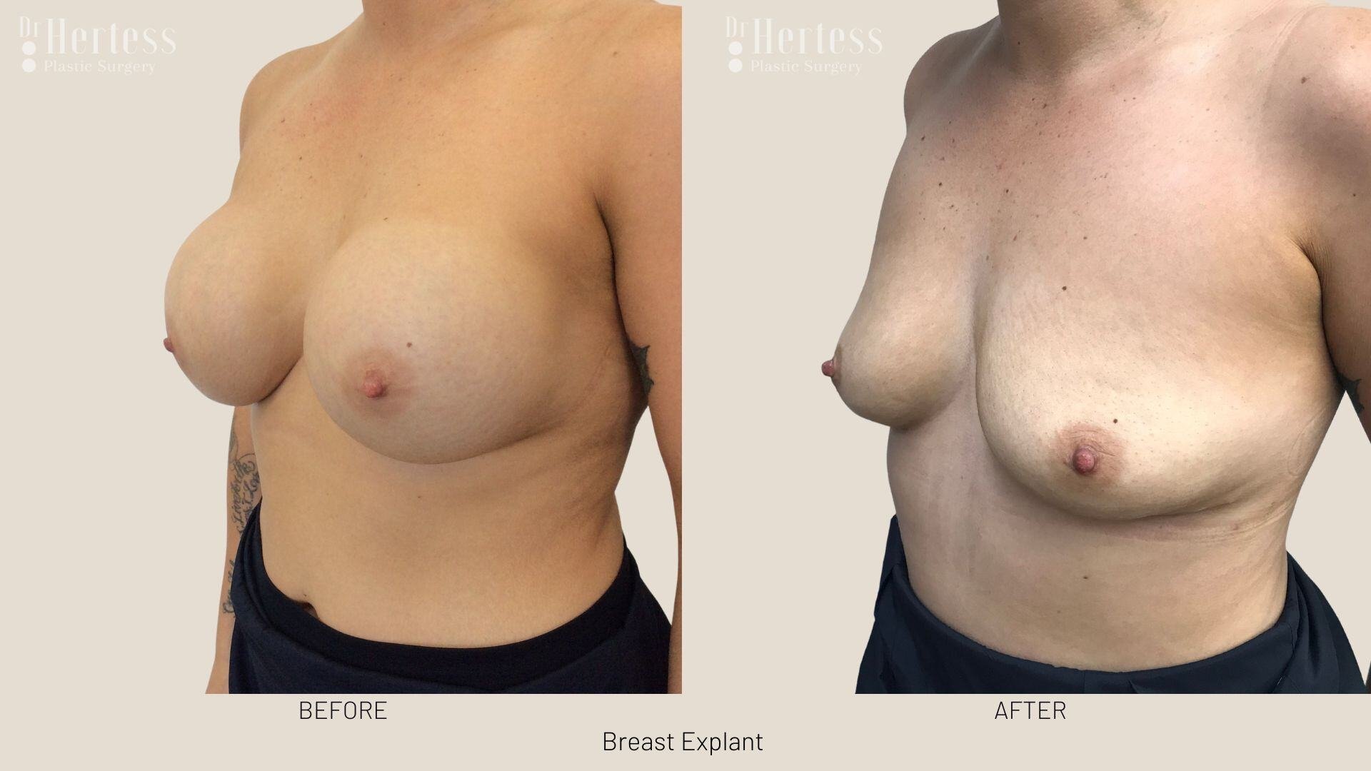 breast implant removal photos