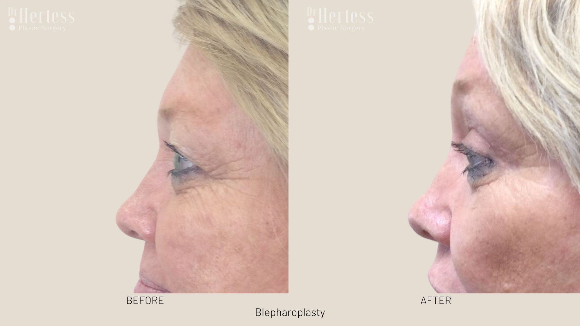 bleph surgery before and after