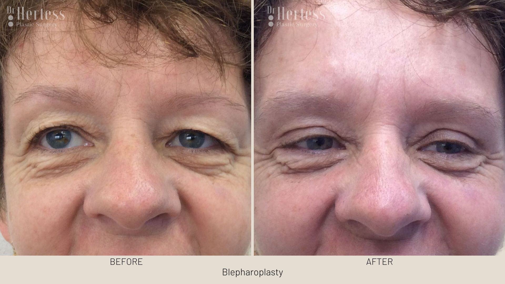 bleph surgery before and after