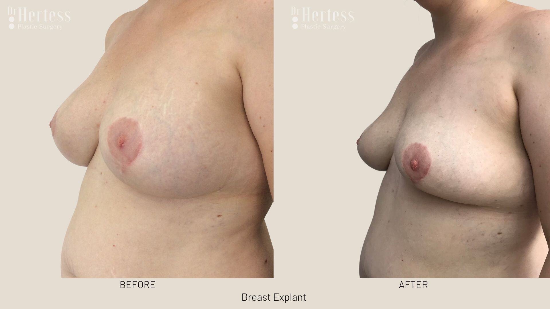 breast implant removal photos
