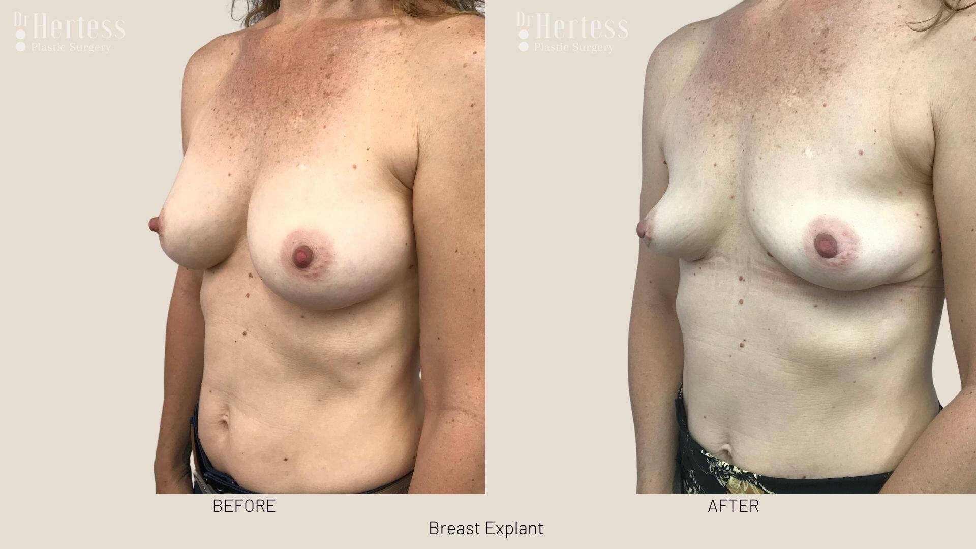 breast implant removal photos