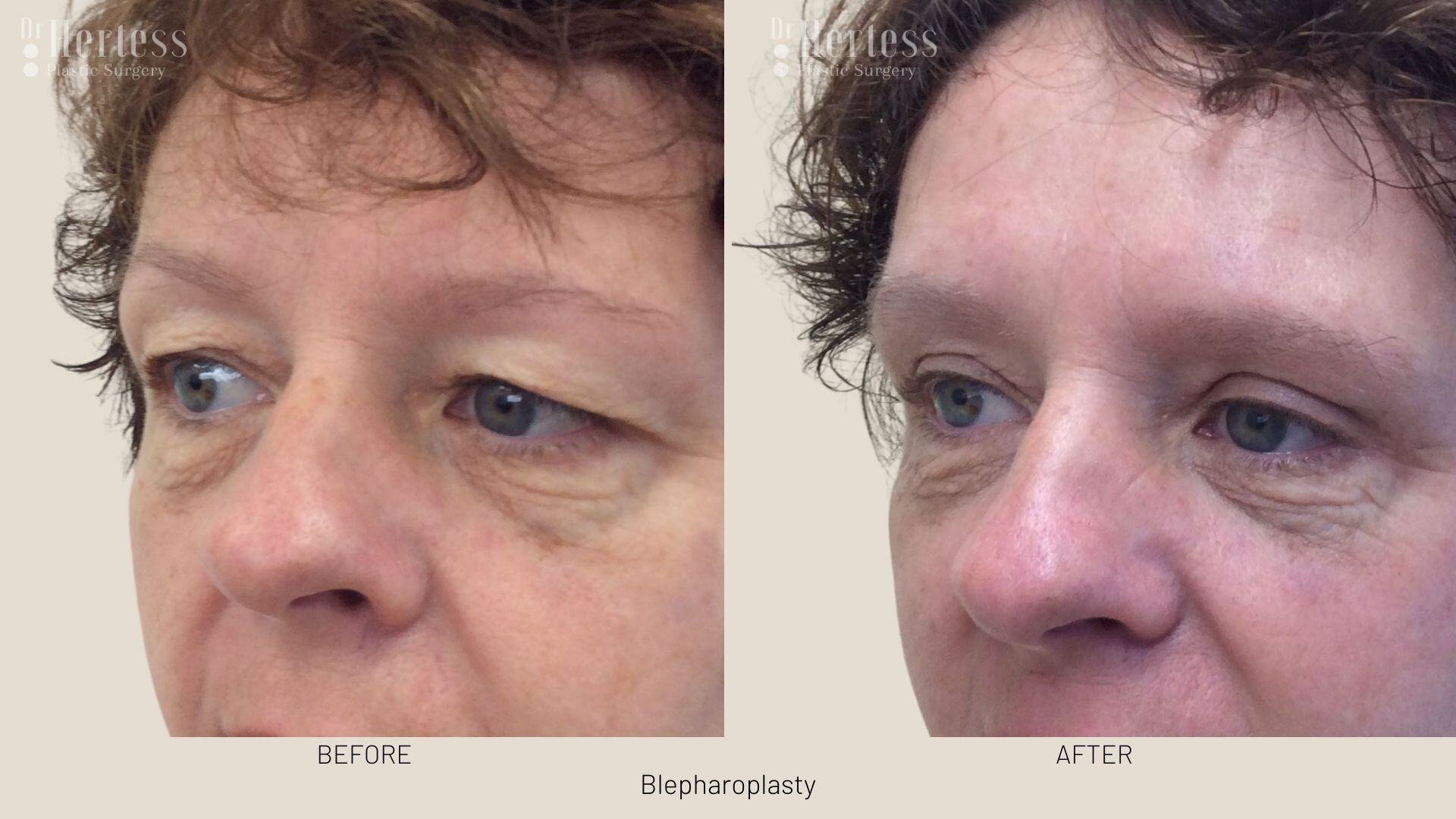 bleph surgery before and after