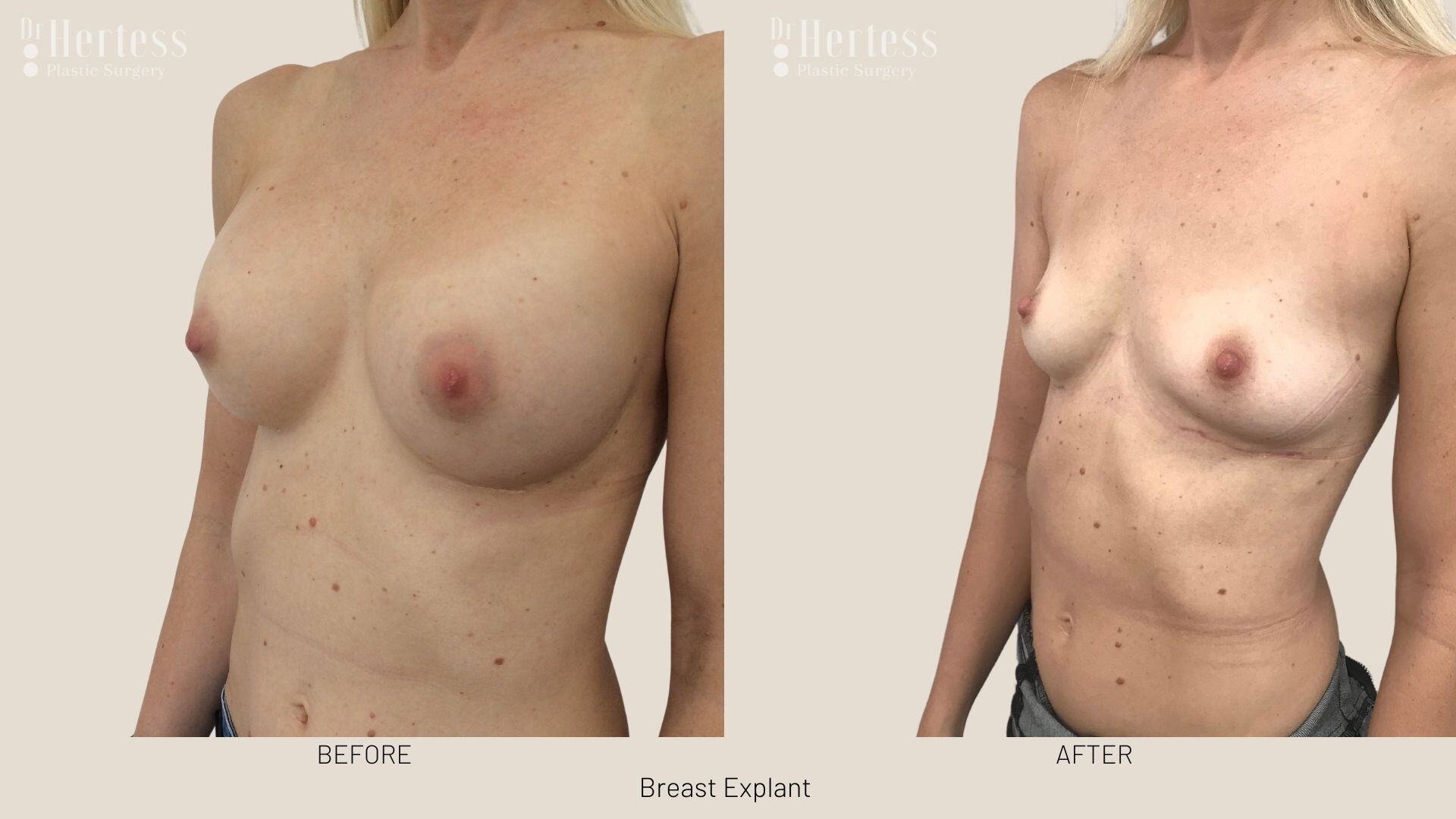breast implant removal photos