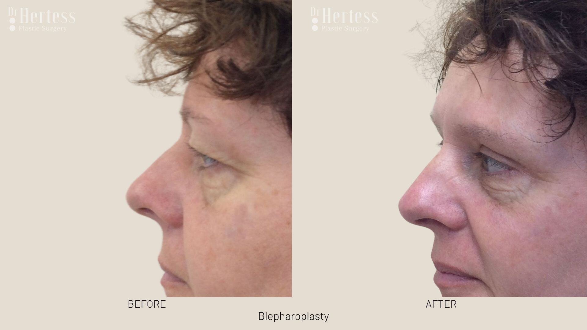 eyelid surgery before and after