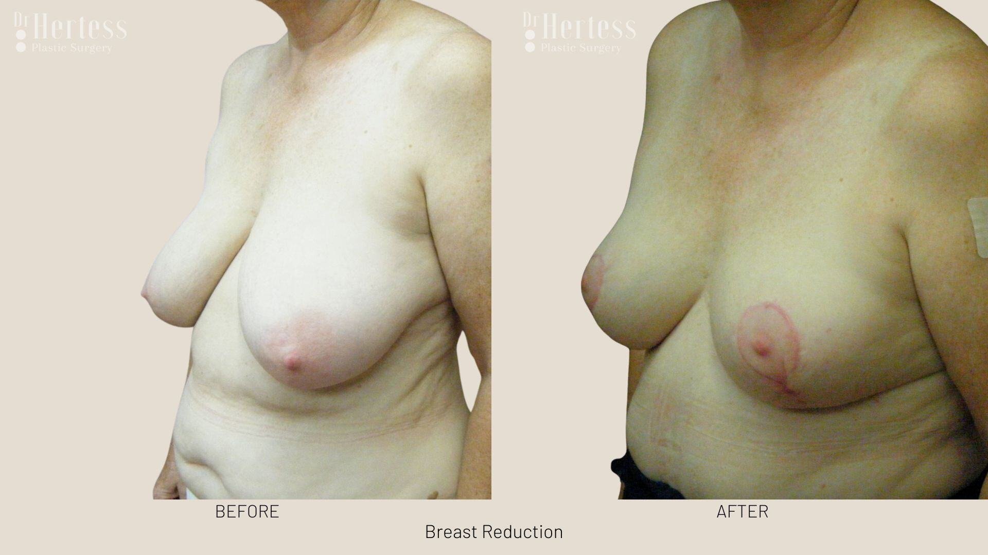 breast reduction before and after