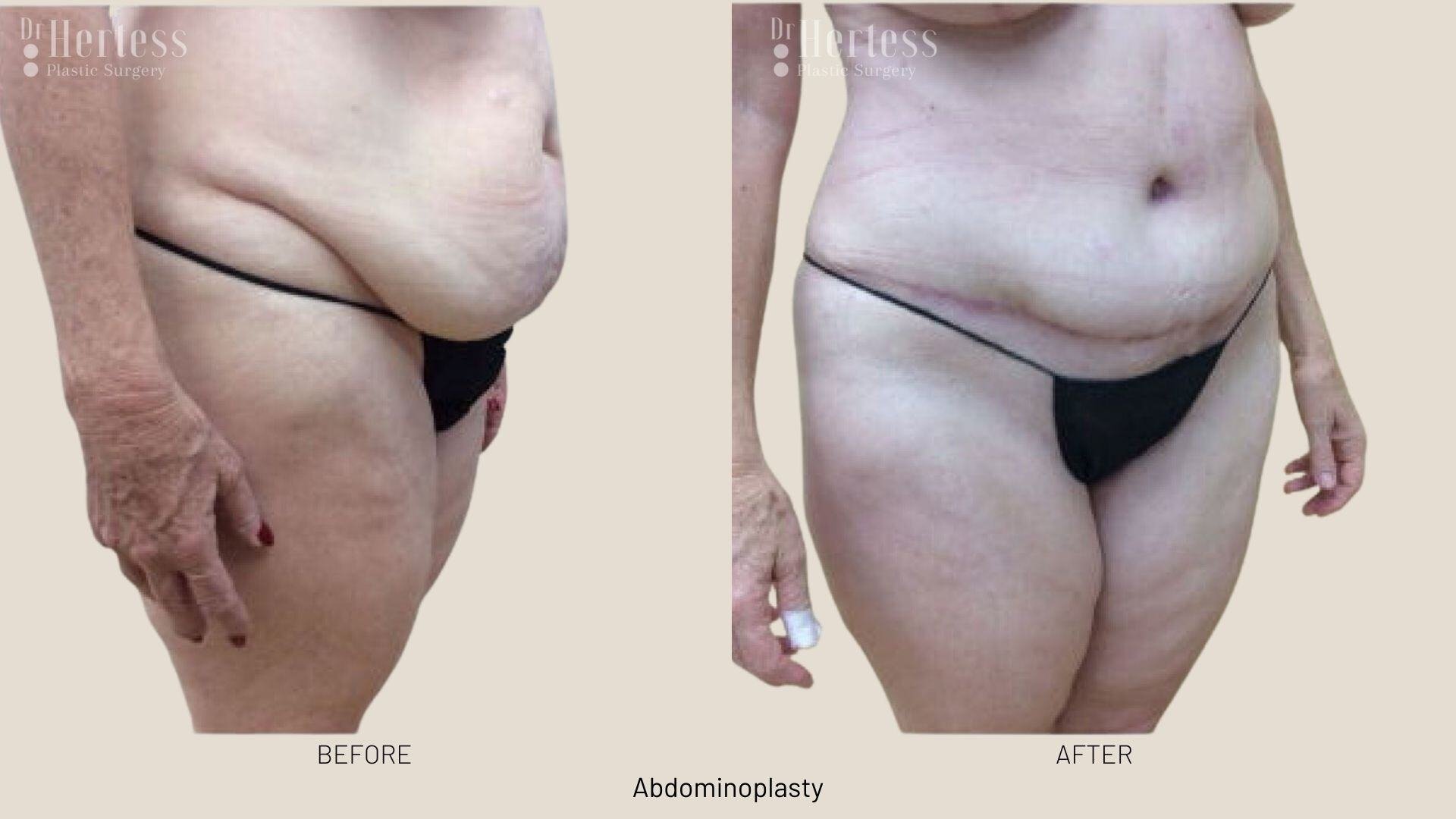 abdominoplasty before and after photos