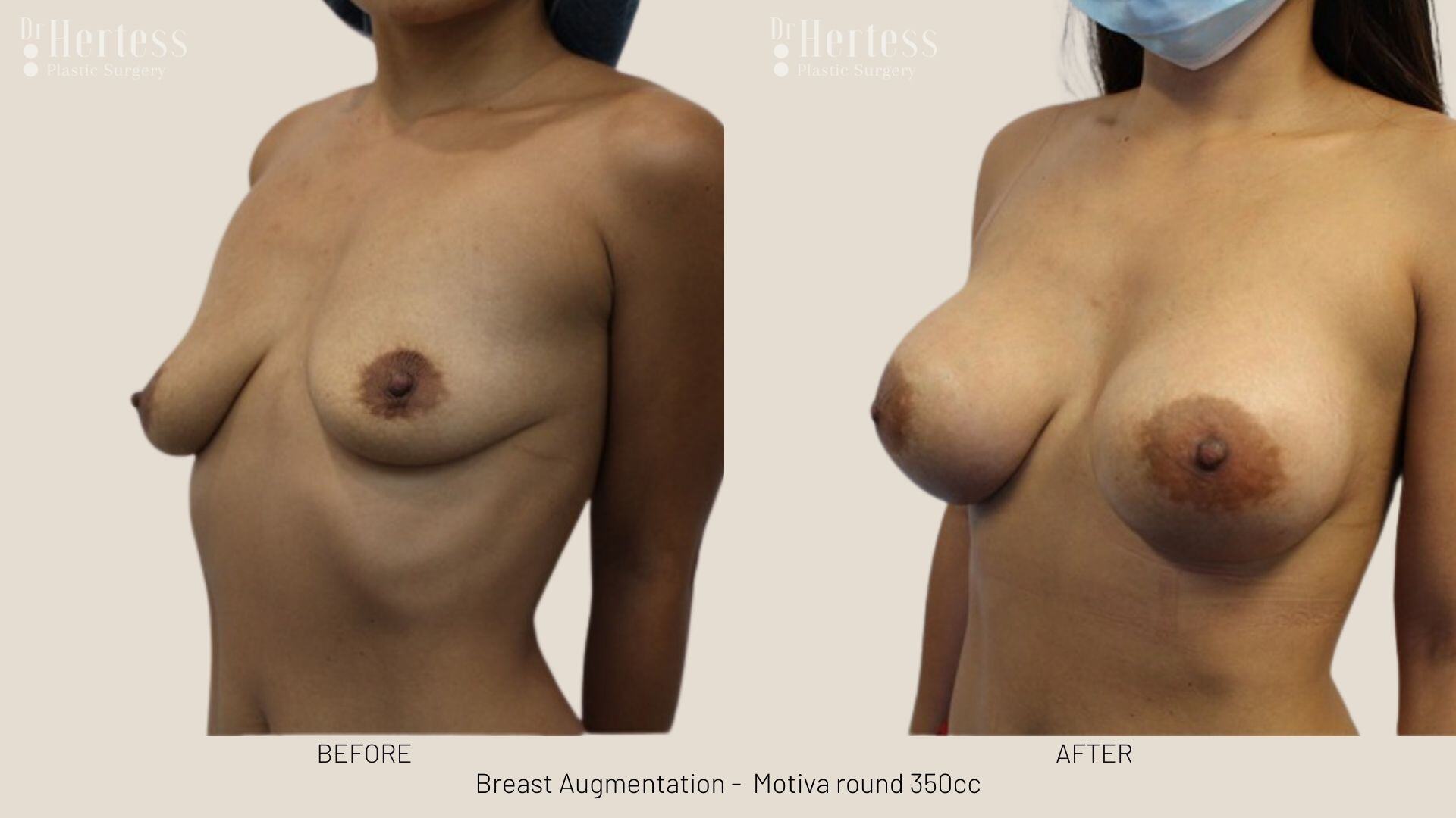 boob job photos before and after